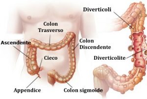 diverticolosi