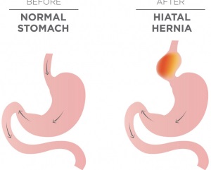 ernia iatale stomaco