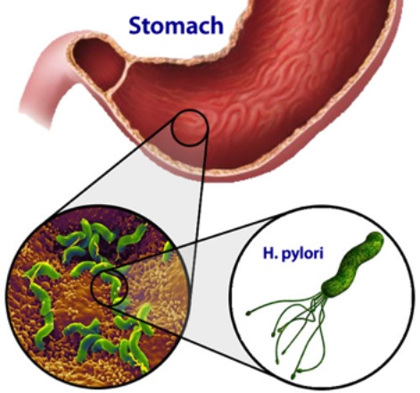 batterio helicobacter pylori